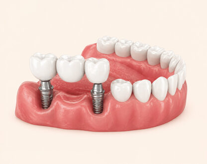 Are Dental Bridges Strong?