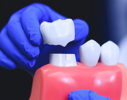 Top Benefits of Dental Crowns in Nashville