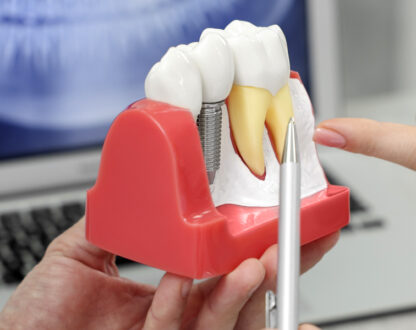 Nashville Dental Implants