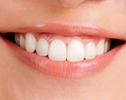 Get Professional Teeth Whitening in Nashville at West Meade Dental