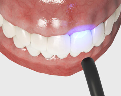 What You Should Know About Dental Bonding