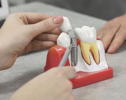 Can You Get Dental Implants Years After Tooth Loss